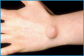 ganglion cyst doctor ganglion cyst doctor